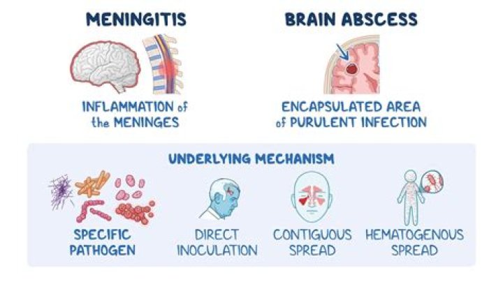 Can h1n1 cause meningitis?