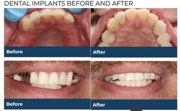 Can I work out before wisdom tooth extraction?