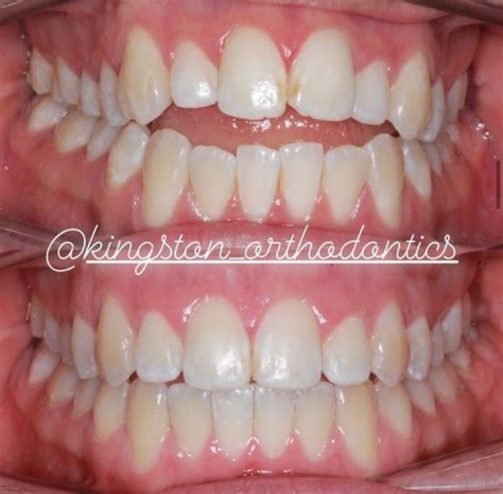 Can Invisalign be used as a night guard?