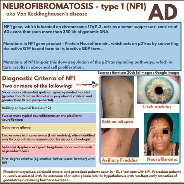 Can NF1 cause blindness?