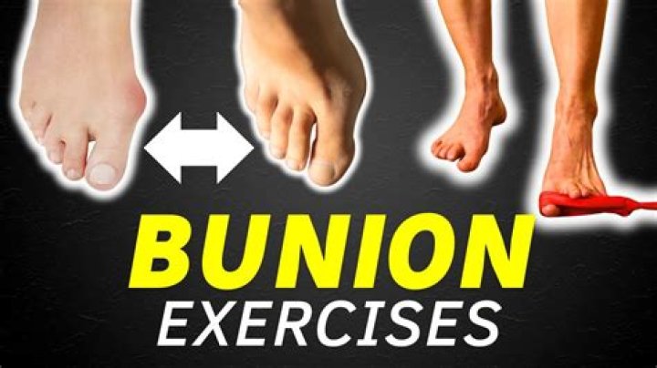 Can physio help bunions?