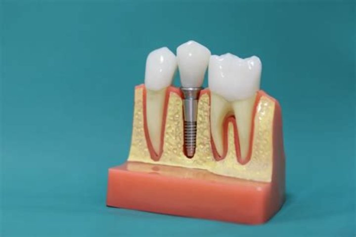 Can you eat rice after dental implant surgery?