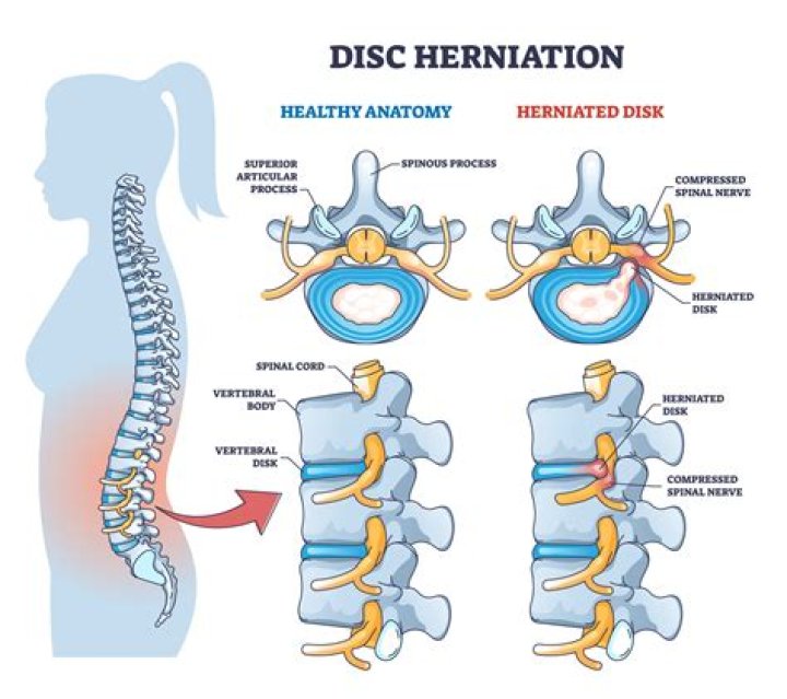 Can you function with a herniated disc?