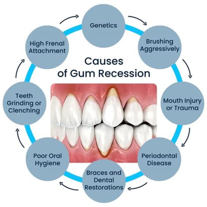 Do crowns cause gum recession?