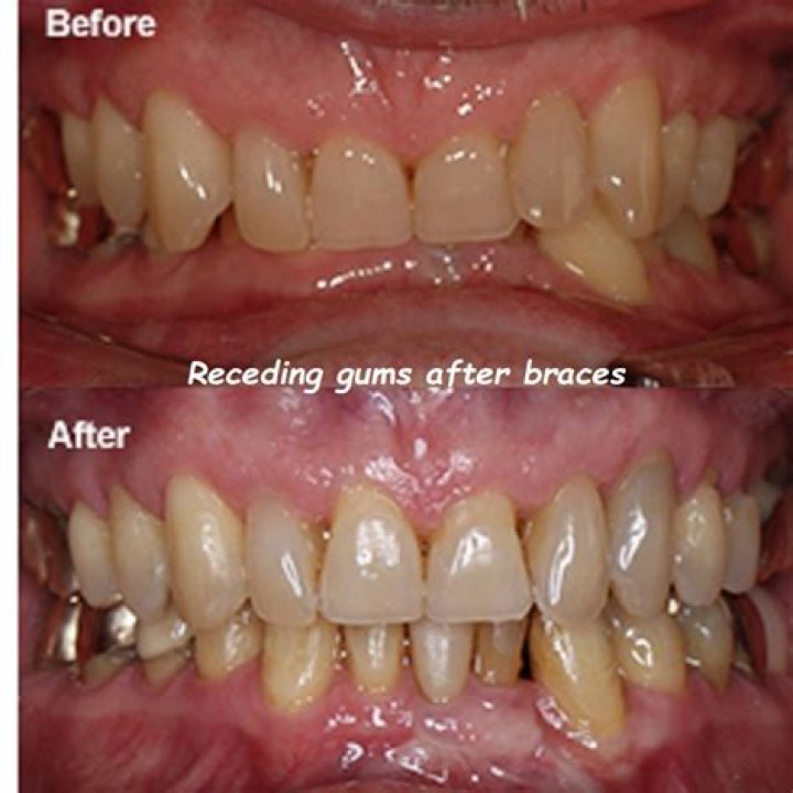 Does gum swelling go down after braces?