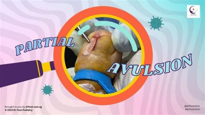 How do you do a partial nail avulsion?