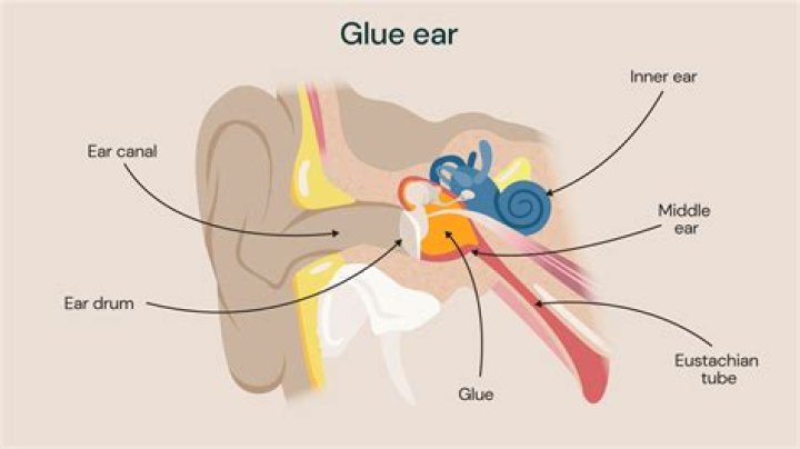 How do you fix a glue ear naturally?