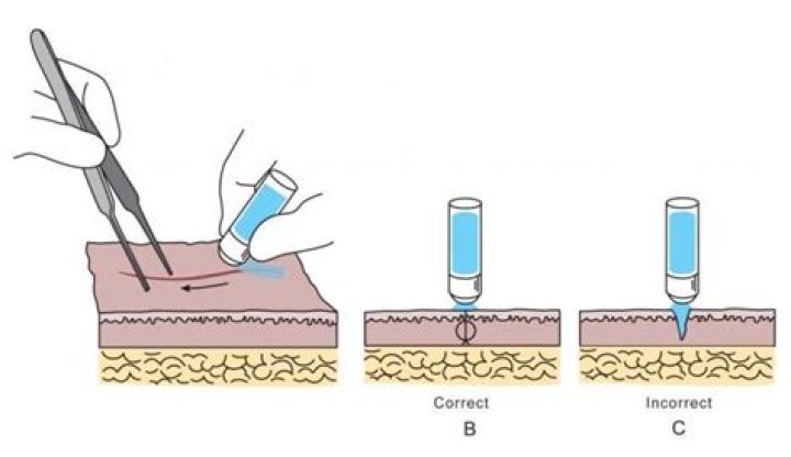 How long until surgical glue comes off?