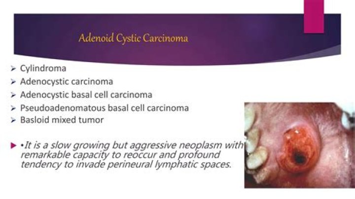 Is adenoid cystic carcinoma fatal?