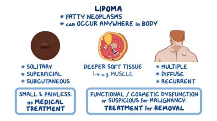 Is Fibroadipose tissue a lipoma?