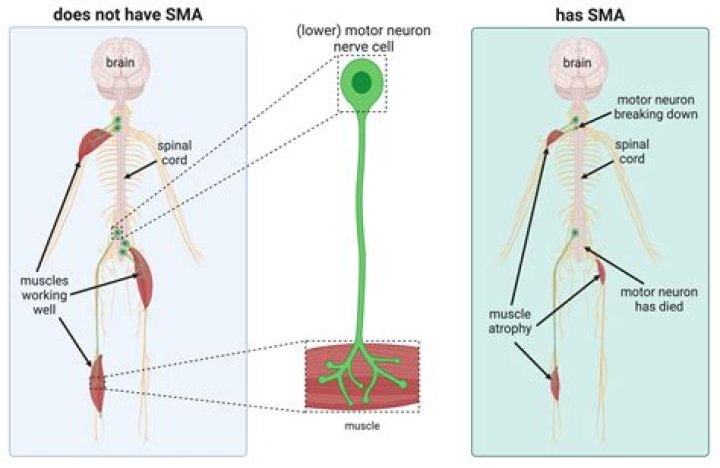Is SMA type 2 fatal?