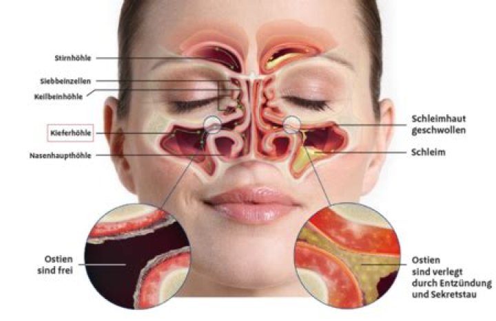 Was ist eine chronische Rhinitis?