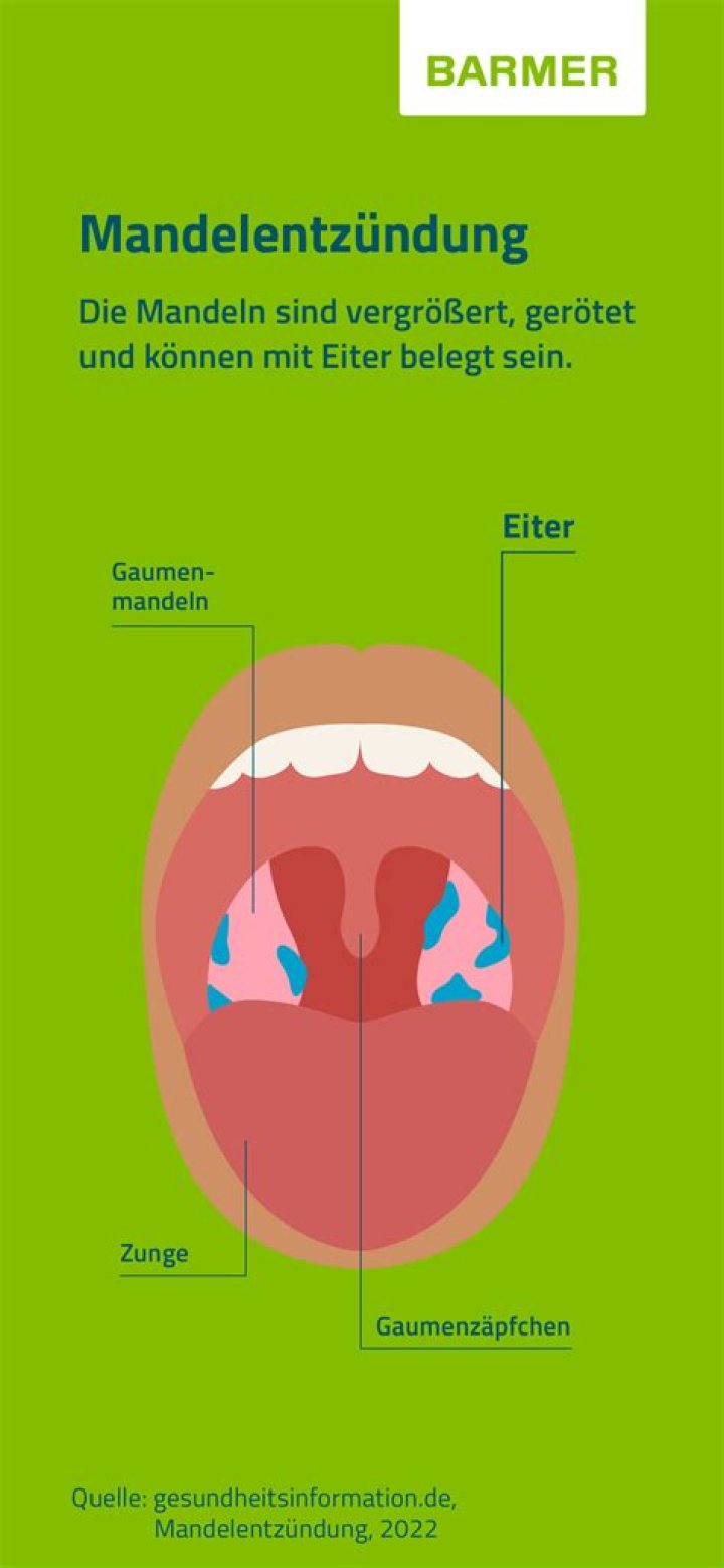 Was tun bei geschwollener Mandel?