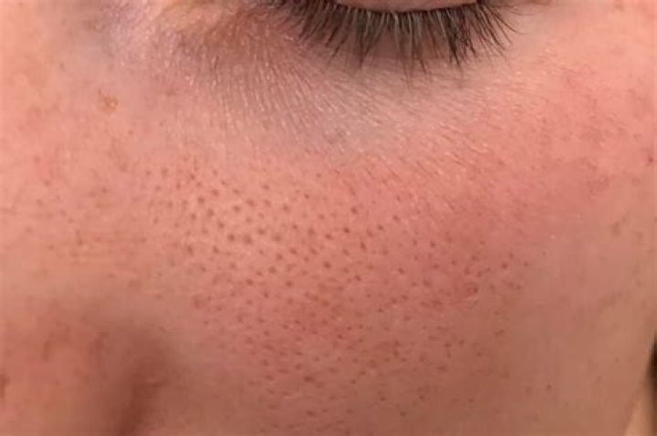 What are the tiny holes in your skin called?