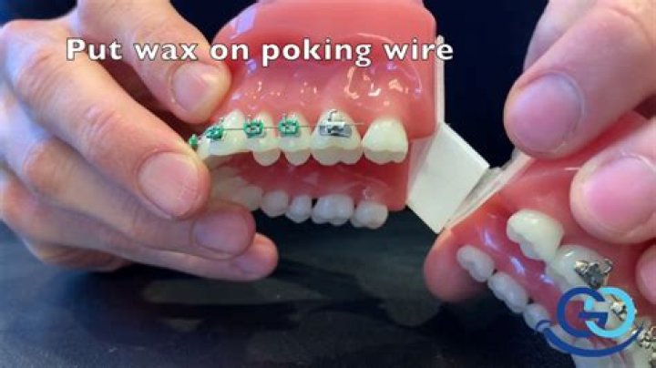 What do I do if my braces wire is poking me?