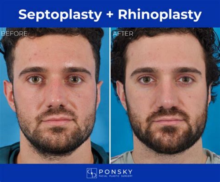 What helps with pain after rhinoplasty?