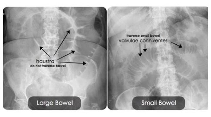 What is a bowel x ray?