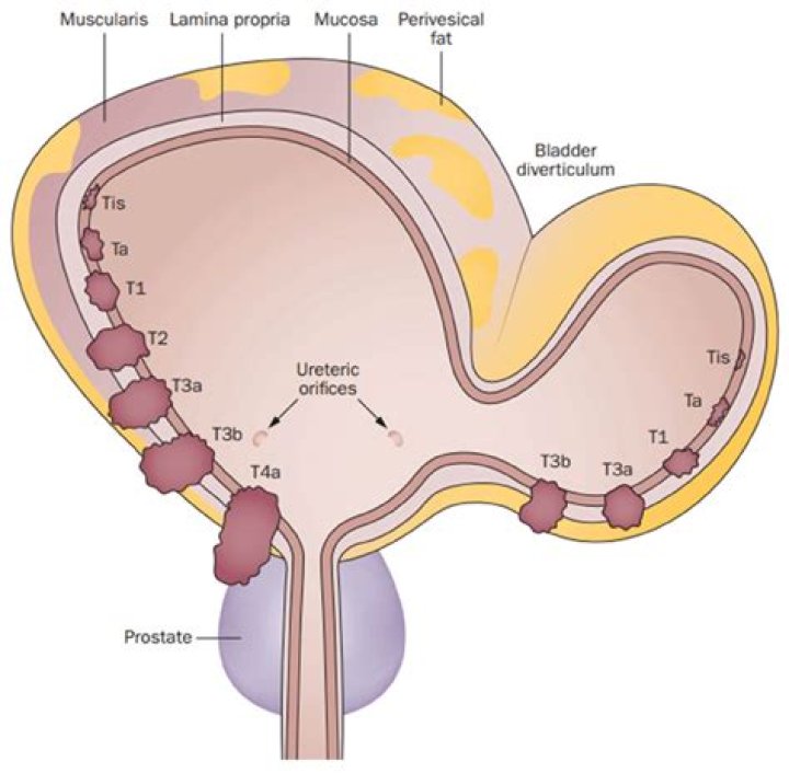 What is bladder diverticulum?