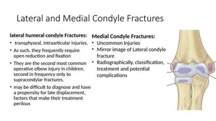 What is condyle fracture?
