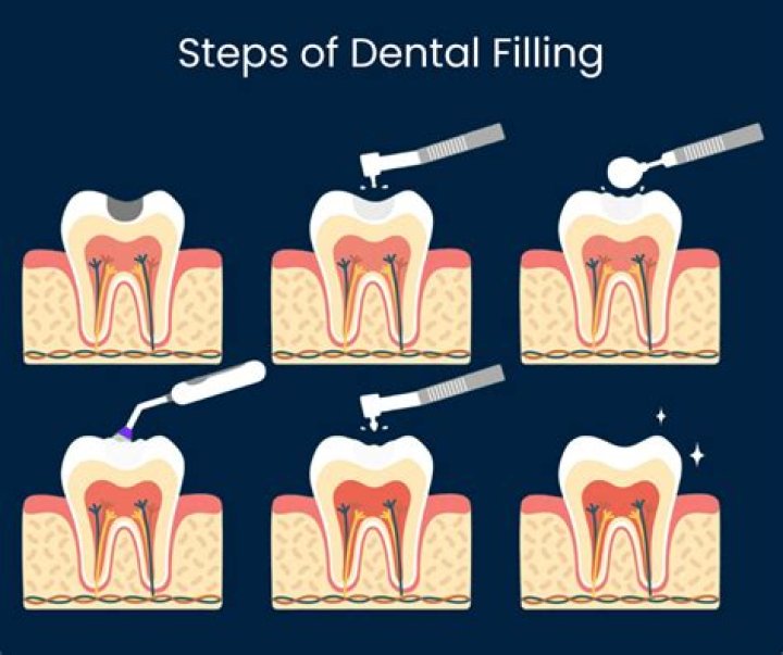 What is filling operation?