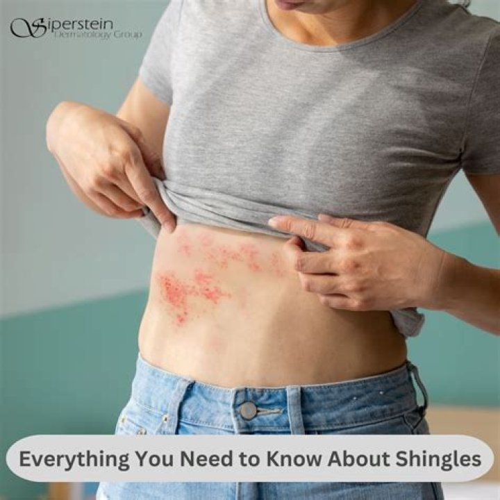 What is the synonym for shingles?