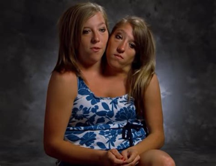 Who are the oldest living Siamese twins?