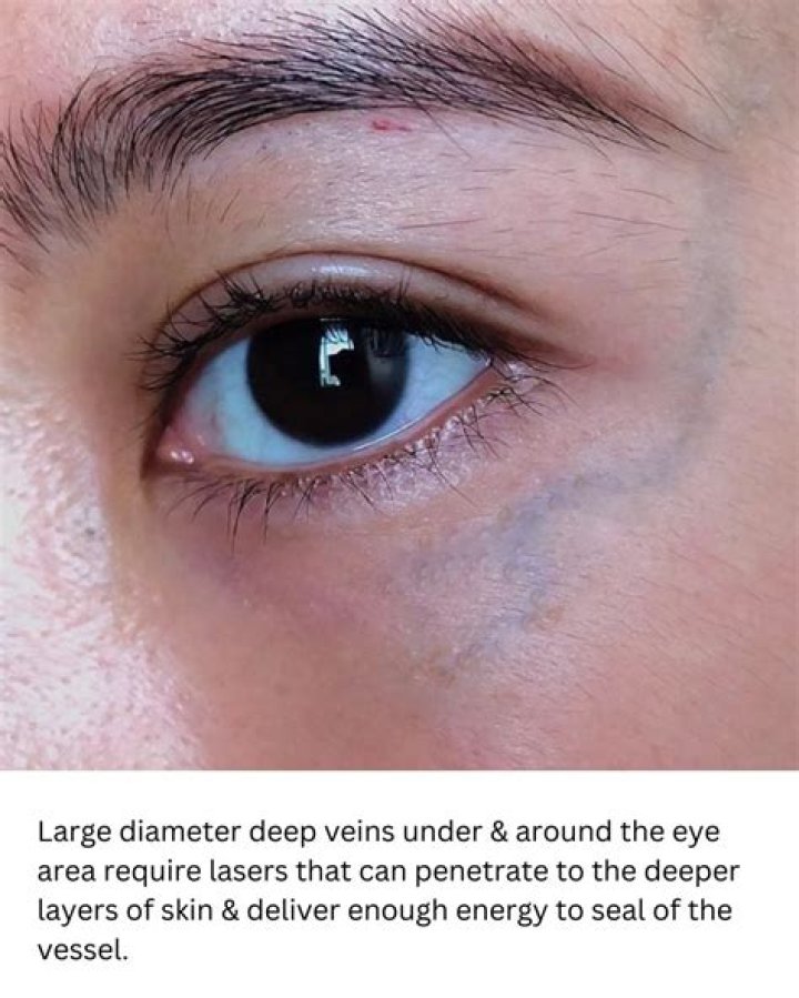 Why do I have blue veins under my eyes?
